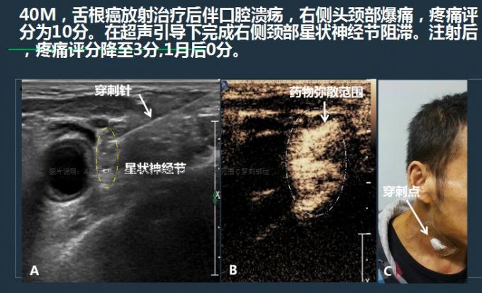 成都医生用“催眠神经”疗法为癌症患者缓解疼痛