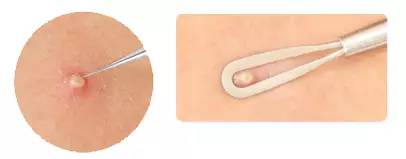 长痘痘怎么才能不留印,长痘痘了怎么消除不留疤