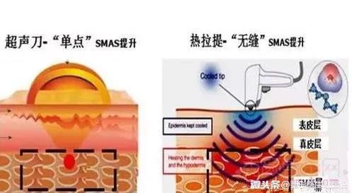 微整形要注意些什么,微整形要注意什么