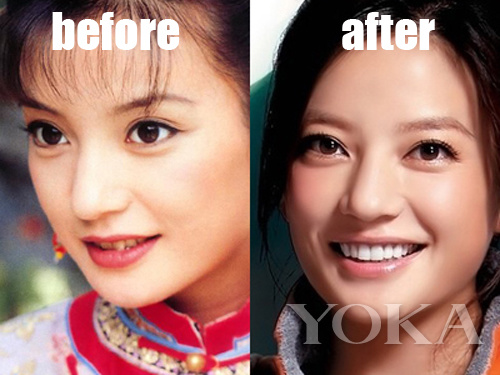 大变脸原来整牙才是高颜值,女星整牙都是越整越美