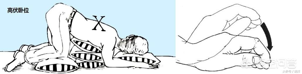 支气管扩张影响寿命吗能治好吗,支气管扩张能治愈吗什么地方能治