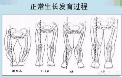 宝宝哪种现象是罗圈腿,青少年罗圈腿的矫正方法
