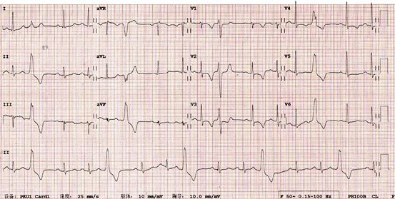 室性心律失常是什么意思,室性心律失常怎么治疗