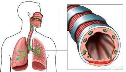 支气管扩张影响寿命吗能治好吗,支气管扩张能治愈吗什么地方能治