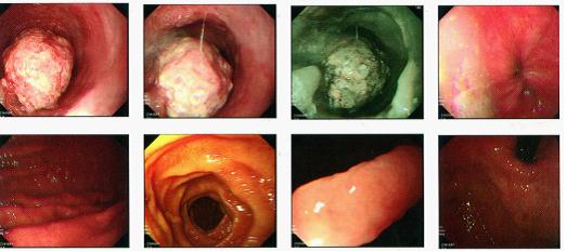 食管鳞状细胞癌病例解析