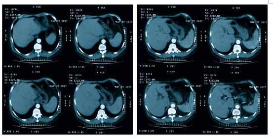 食管鳞状细胞癌病例解析