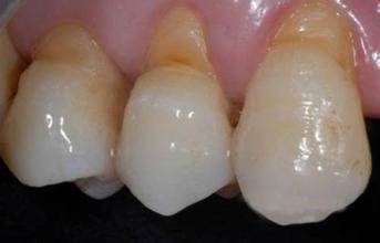 口腔医学教你如何正确刷牙,横拉锯式刷牙