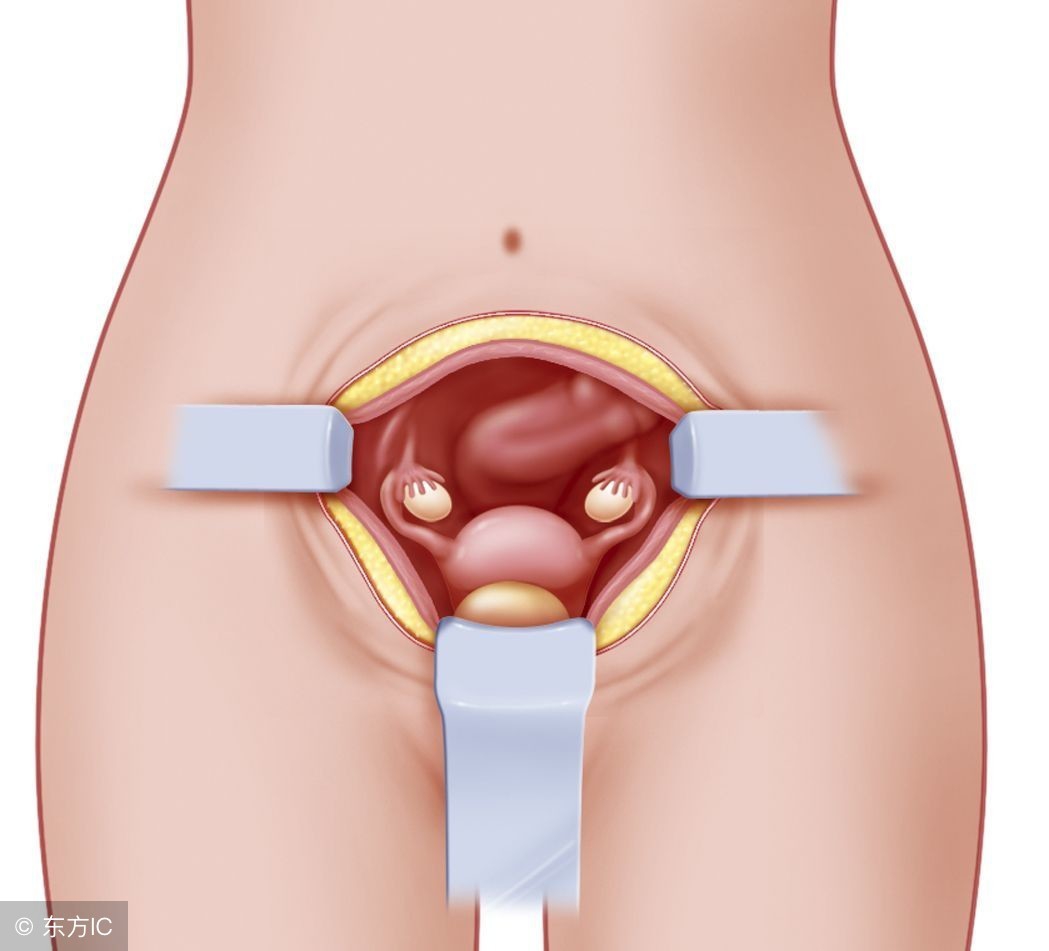 子宫内膜息肉手术后感染症状,老年人子宫内膜息肉的症状