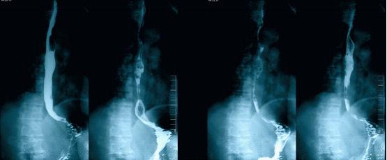 食管鳞状细胞癌病例解析