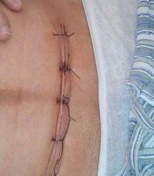 剖腹产后正常的刀口是什么样子的?要怎么护理呢?