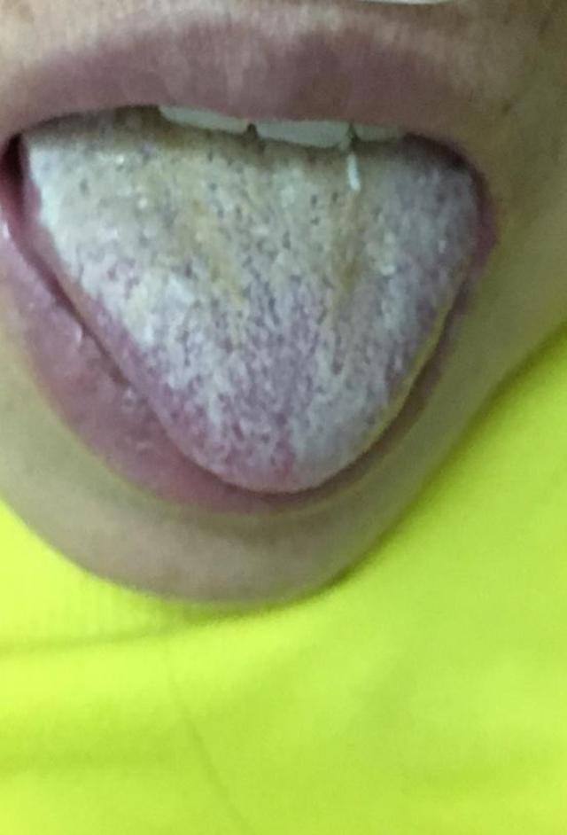 感冒咳嗽肺部感染中药配方,肺部感染中药经典处方医案