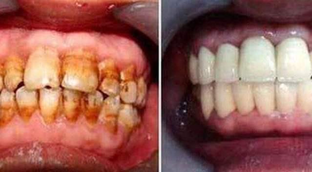 每天刷牙牙齿还是发黄是怎么回事,饮用含氟量过大的水导致牙齿发黄