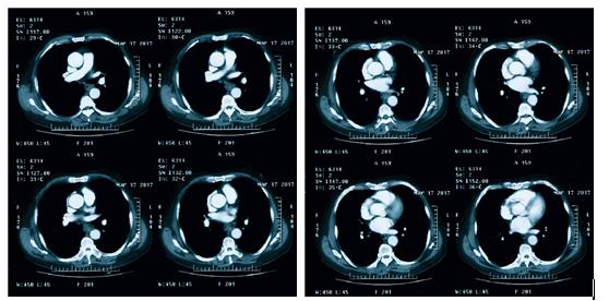 食管鳞状细胞癌病例解析
