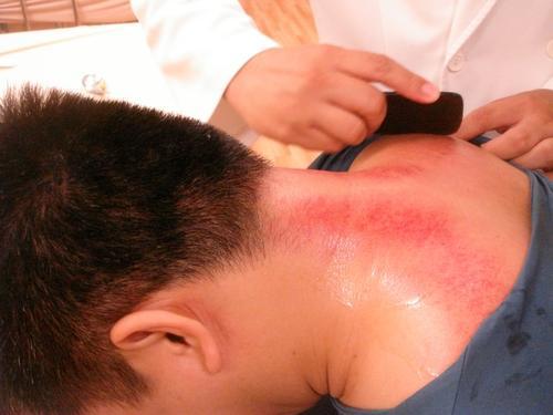 风寒感冒刮痧刮哪个部位,感冒鼻子不通气刮痧刮哪个部位