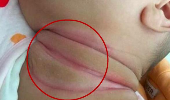 1岁宝宝脖子有黑点点,1岁宝宝脖子有红色斑块