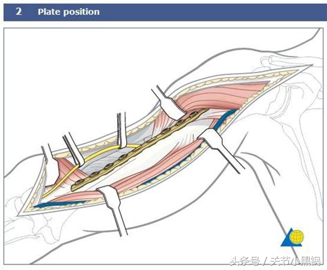 脚踝骨折取钢板后还用打石膏吗,距骨骨折固定钢板后多久拆除石膏