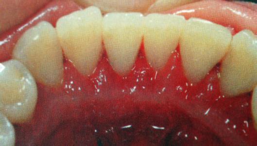 每天刷牙牙齿还是发黄是怎么回事,饮用含氟量过大的水导致牙齿发黄