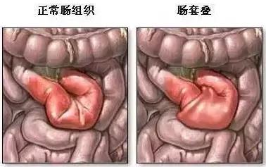 恐怖的肠套叠经历抓住救命黄金12小时