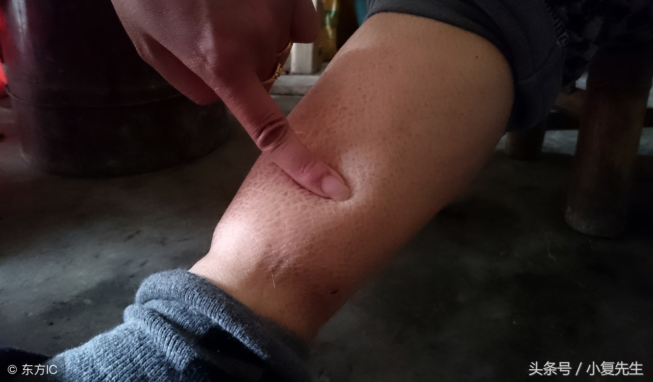 肾病综合征只能用激素治吗,肾病综合征用激素治疗可以吗