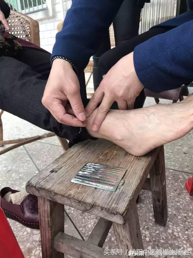 治疗带状疱疹用针灸和放血,带状疱疹内针治疗