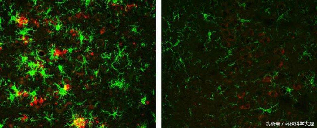 美国预防老年痴呆新药,新突破老年痴呆