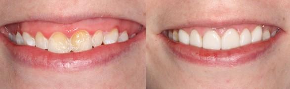 每天刷牙牙齿还是发黄是怎么回事,饮用含氟量过大的水导致牙齿发黄