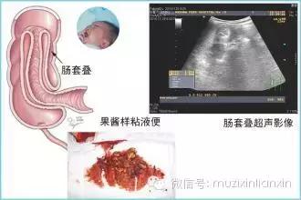 恐怖的肠套叠经历抓住救命黄金12小时