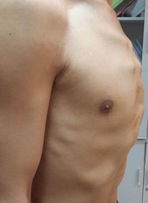 桶状胸手术,先天性桶状胸