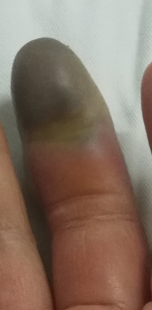 糖尿病要截掉手指是什么情况,糖尿病手指截掉是怎么回事