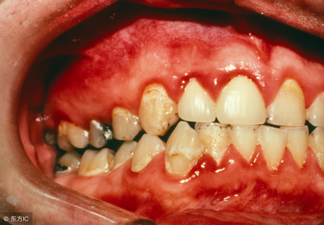 孕妇牙龈发炎化脓对胎儿有影响吗,孕妇牙龈突然出血是怎么回事呢