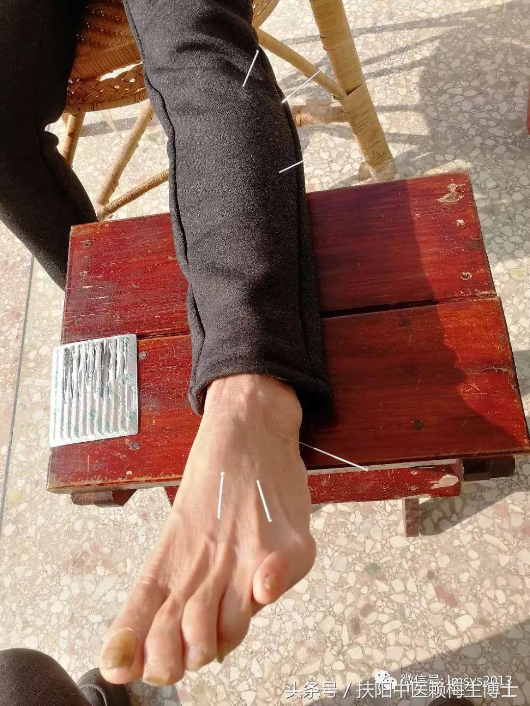 治疗带状疱疹用针灸和放血,带状疱疹内针治疗