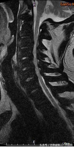 颈椎病折磨了20年,重度颈椎病的外科治疗