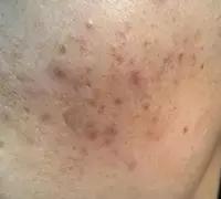 痘痘留下的黑红色痘印怎么去除,痘痘消下去有痘印怎么办