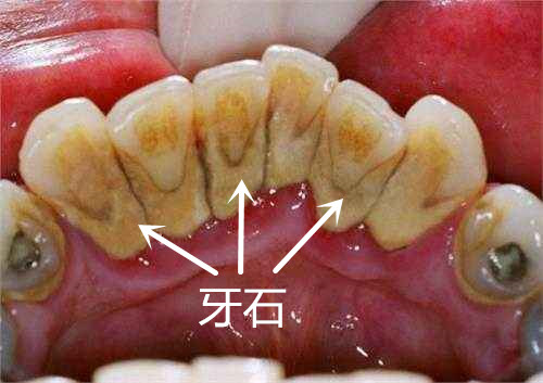 孕妇牙龈发炎化脓对胎儿有影响吗,孕妇牙龈突然出血是怎么回事呢