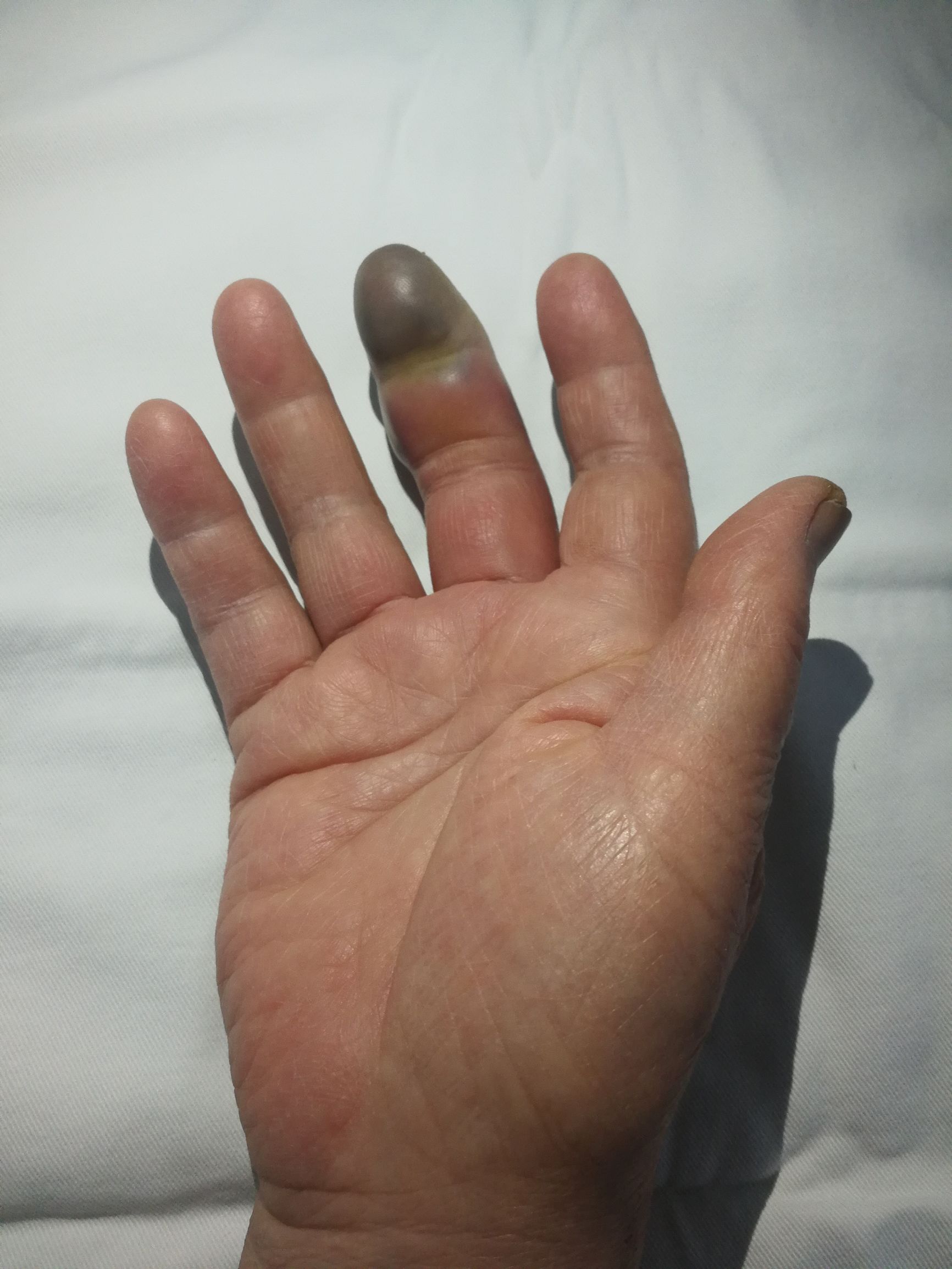 糖尿病要截掉手指是什么情况,糖尿病手指截掉是怎么回事