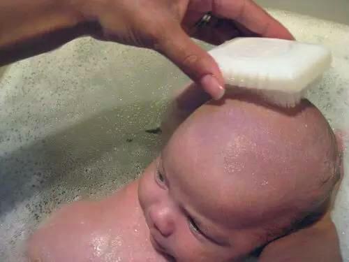 宝宝头上的乳痂弄掉后头皮变红,宝宝头皮乳痂应该如何处理