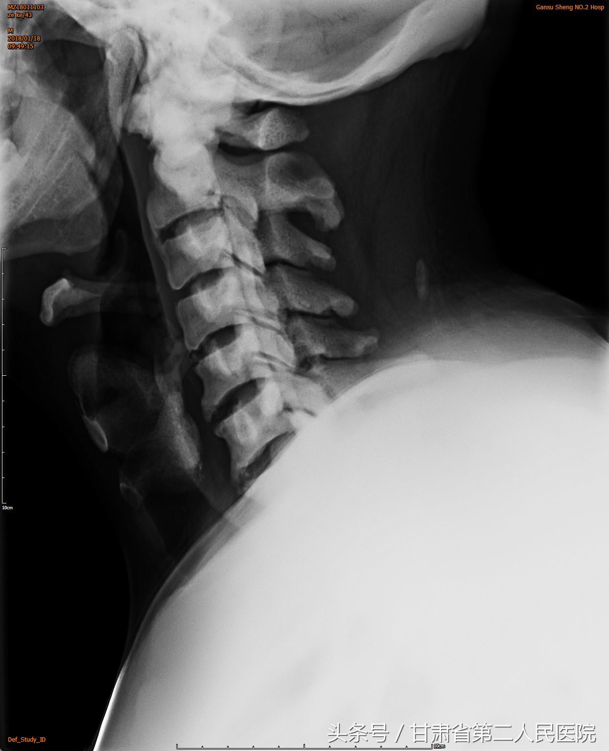 颈椎病折磨了20年,重度颈椎病的外科治疗