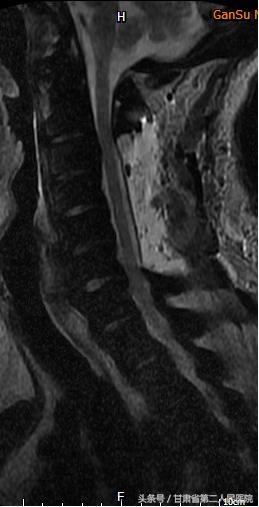 颈椎病折磨了20年,重度颈椎病的外科治疗