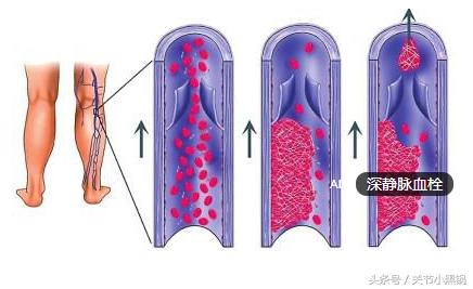 脚踝骨折取钢板后还用打石膏吗,距骨骨折固定钢板后多久拆除石膏