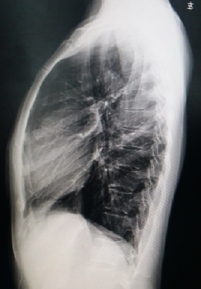 鸡胸超微创手术,鸡胸微创手术3d图