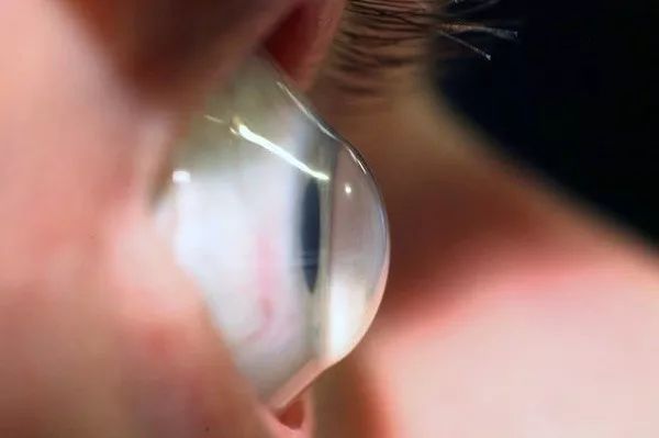 激光近视手术真的靠谱吗,激光近视手术靠谱吗