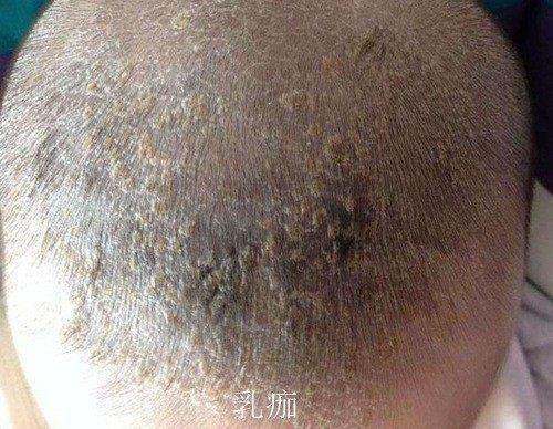 宝宝头上的乳痂弄掉后头皮变红,宝宝头皮乳痂应该如何处理