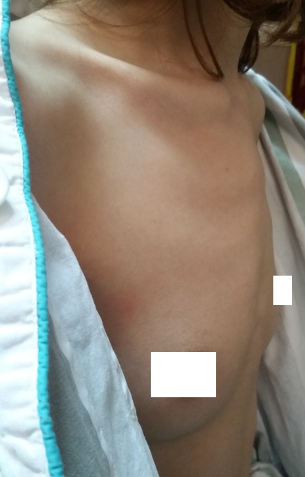 鸡胸超微创手术,鸡胸微创手术3d图