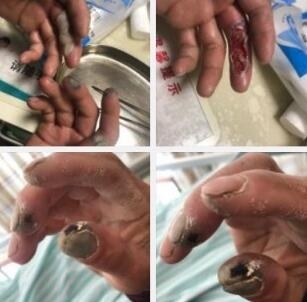 环卫工双手被强酸腐蚀,环卫工双手被腐蚀责任