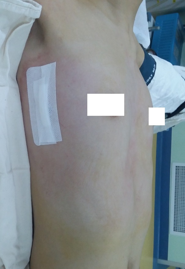 鸡胸超微创手术,鸡胸微创手术3d图