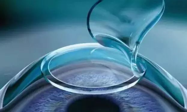 激光近视手术真的靠谱吗,激光近视手术靠谱吗