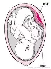 产科医生一般不会告诉你,这5种情况他们可能会考虑采取剖宫产!