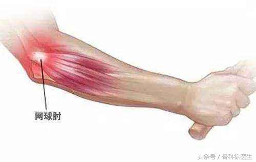 网球肘小臂疼痛难忍,如何缓解网球肘胳膊疼痛