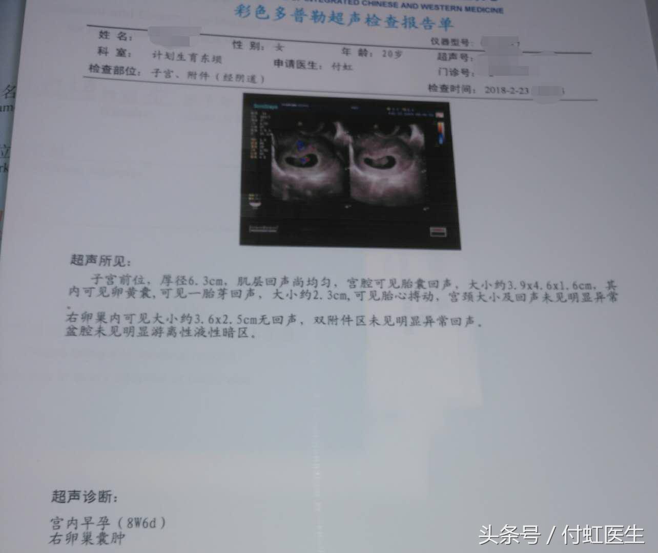 怀孕8周卵巢囊肿要不要紧,怀孕后8cm的卵巢囊肿自己消失了
