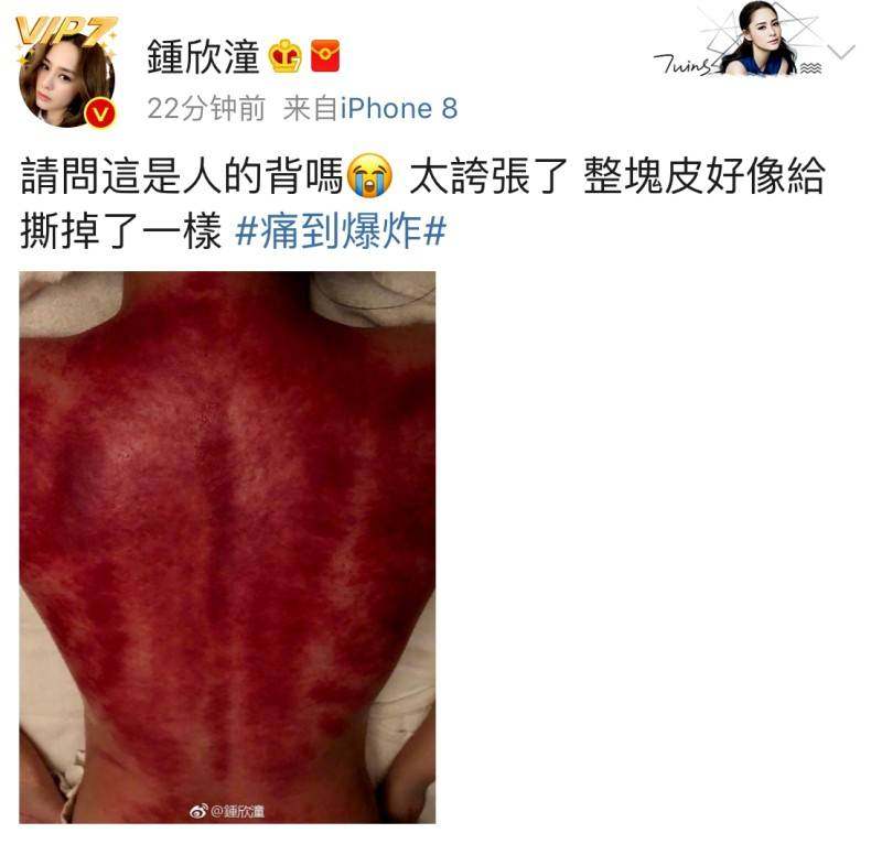 阿娇晒出刮痧照片，看第一眼以为是生牛肉！网友担心影响生孩子